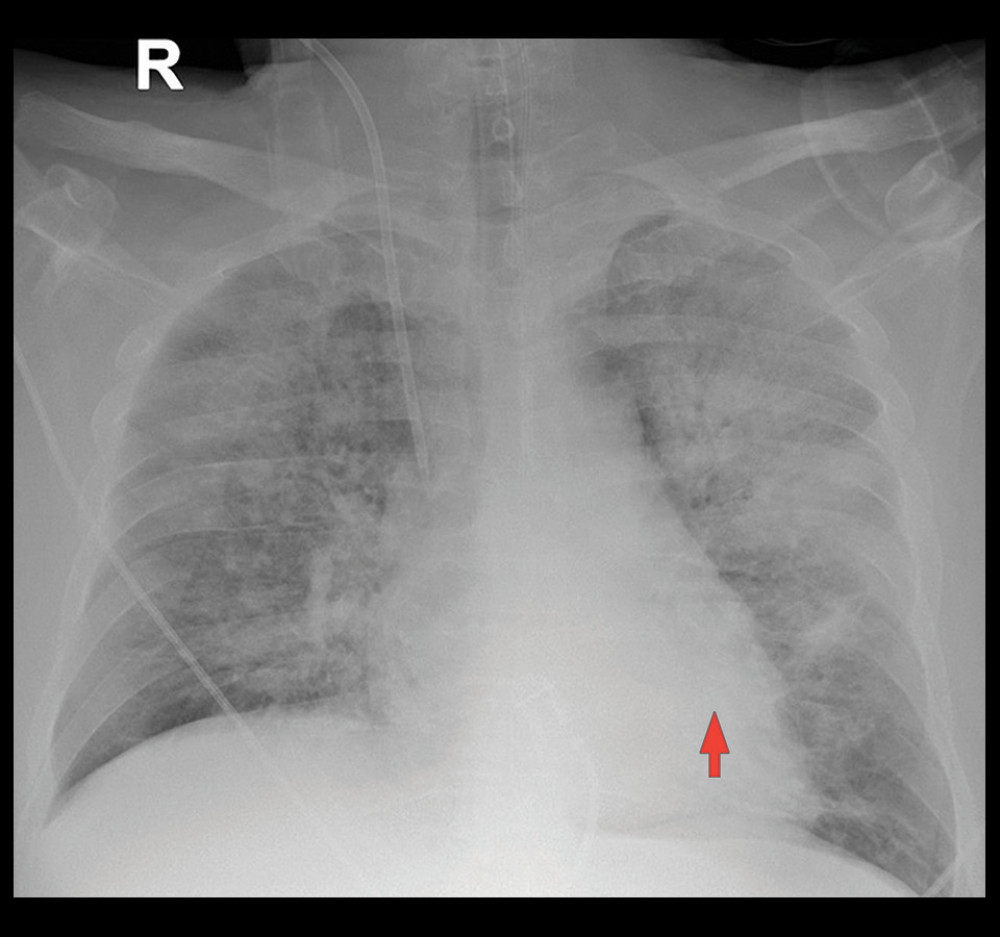 Progression of bilateral pneumonia on lung radiography compared to previous findings.