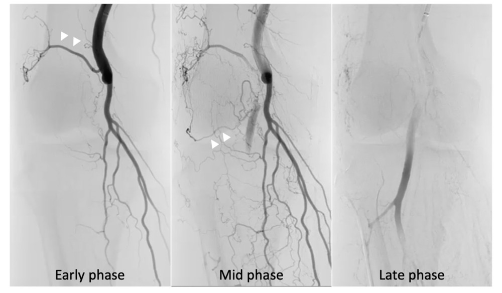 Pre-procedural digital subtraction angiography. Baseline angiography showed complete occlusion of the right P2 segment. An ipsilateral collateral pathway (arrowheads) supplied the distal popliteal artery.