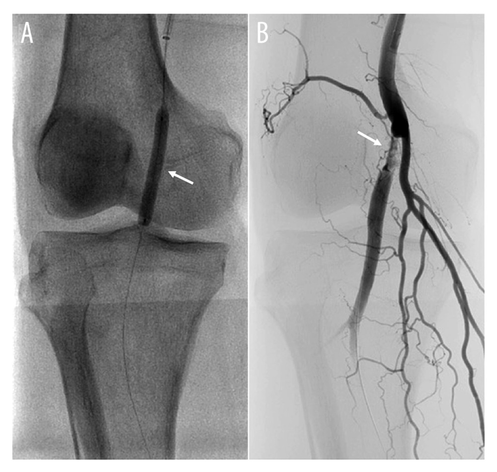 Conventional endovascular procedure. Angiography after plain balloon angioplasty of a right popliteal occlusive lesion (A, arrow) confirmed severe residual stenosis with delayed blood flow (B, arrow).