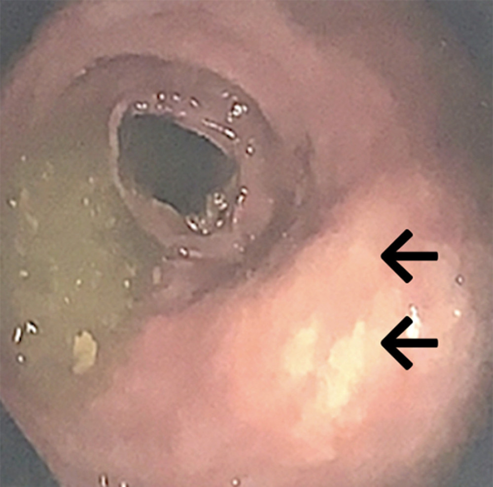 Endoscopic view of the cecum and ileocecal valve (black arrows).