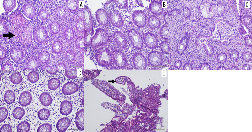 Photomicrograph of biopsy showing the pathological features of Crohn’s disease. (A) Biopsy of the rectal mucosa site, showing inflammatory infiltrate rich in plasma cells and eosinophils, with the presence of non-necrotizing epithelioid granuloma (black arrow) (20× magnification). (B) Biopsy of the mucosa of the left colon characterized by distorted and mucin-depleted glands, with chronic inflammatory infiltrate, rich in plasma cells and eosinophils, with activity (20× magnification). (C) Biopsy of the mucosa of the right colon with evident glandular distortion and presence of cryptic abscesses (20× magnification). (D) Biopsy of the mucosa of the transverse colon with inflammatory sparing of the glandular elements (skip lesion) (20× magnification). (E) Ileal mucosa, with rare residual villi (black arrow), with intense chronic active inflammatory infiltrate and mucosal damage (10× magnification).