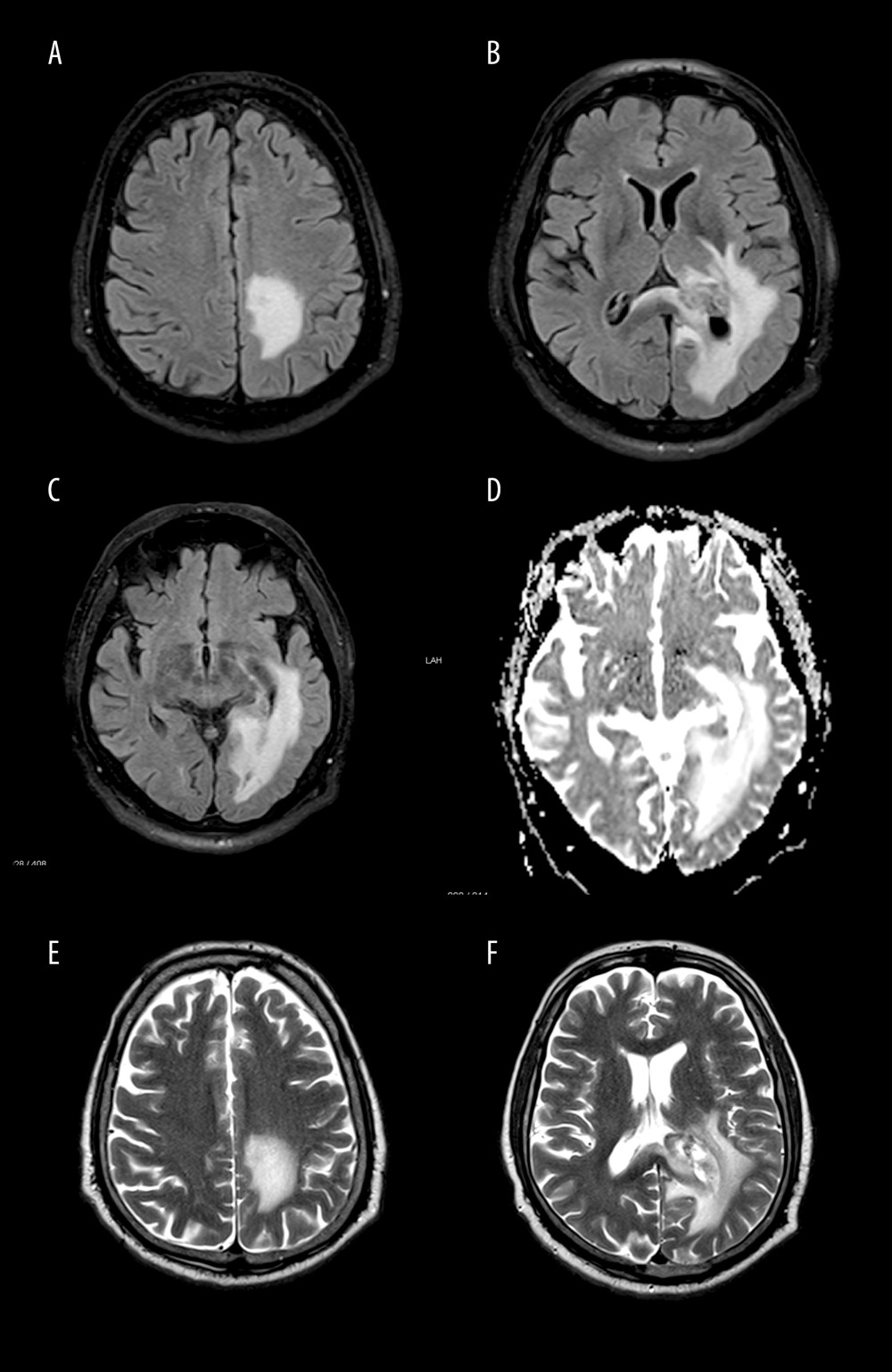Multiple axial views of the magnetic resonance imaging (MRI) showing left lateral ventricle lesion with mild diffuse dural enhancement, with multiple series. (A–C) Represent series of T2 TIRM (turbo inversion recovery magnitude) dark fluid. (D) Represents series of DWI (diffusion weighted imaging). (E, F) Represent series of T2 TSE (turbo spin-echo).