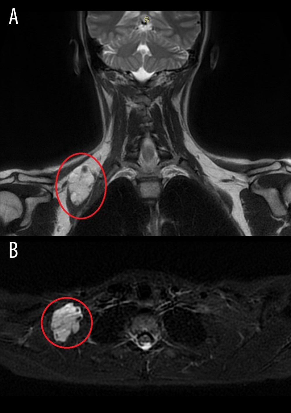 (A) Coronal T2 HR FSE Propeller; (B) axial T2 STIR. A 43×30×49 mm formation with lobulated contours is closely related to muscular layers (circles). The signal is mostly fluid (likely serohematic contents) and few calcifications are present.