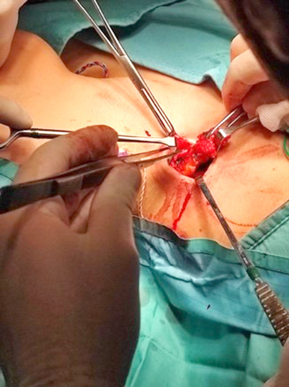 Surgical field. Small skin incision; a mass in the left supraclavicular fossa can be seen.