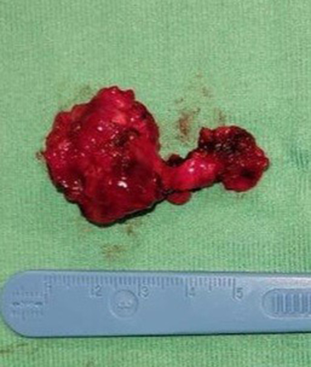 Resection “en-bloc” of the mass. Macroscopically, the mass was 5.5×3×3.5 cm in size.