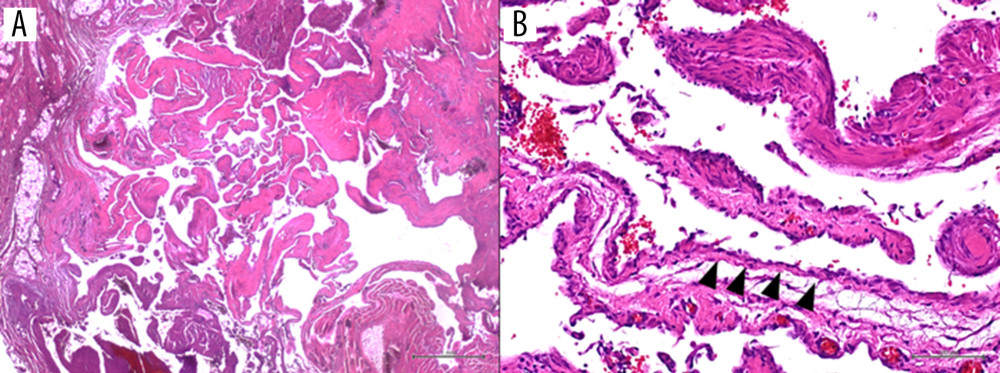 (A) Vascular malformation containing organizing thrombus with papillary endothelial hyperplasia (H&E, 2.5× magnification, scale bar 1mm). (B) Papillae with hyalinized hypocellular cores covered by flattened endothelium (black arrow-head) (H&E, 20× magnification, scale bar 100 µm).
