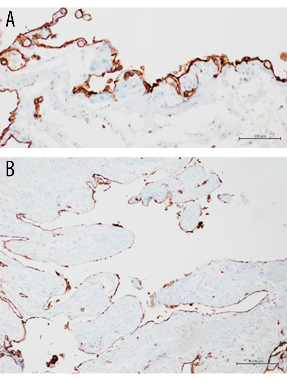Immunohistochemical analysis showed endothelial positivity for CD34 (A: 20× magnification, scale bar 100 µm) and CD31 (B: 10× magnification, scale bar 200 µm).