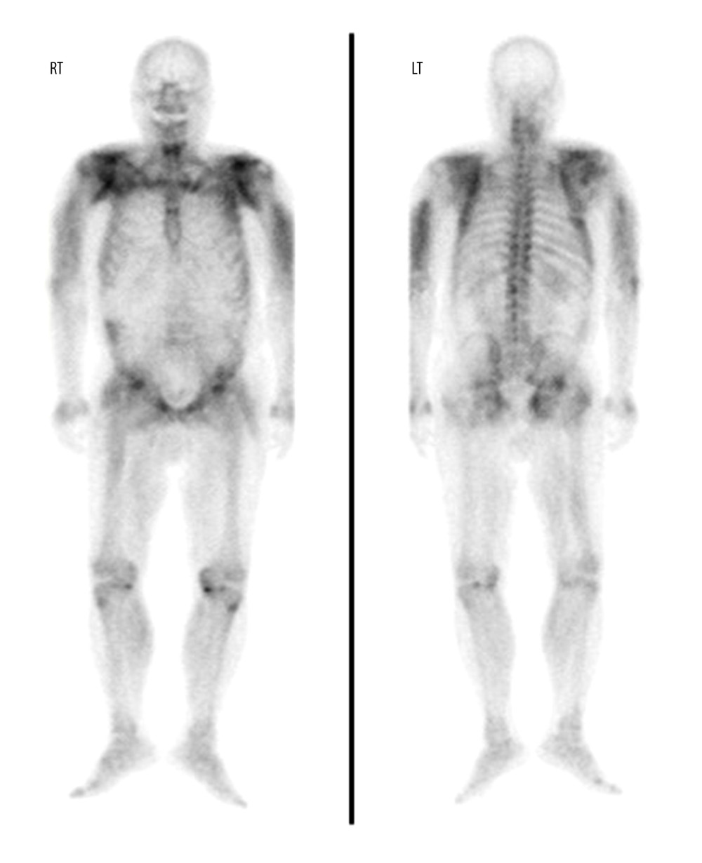 Technetium-99m hydroxymethylene diphosphonate (99mTc-HDP) bone scintigraphy on hospitalization day 10 revealed increased soft tissue uptake of radiotracer in both shoulders, upper arms, and gluteal areas. RT – right; LT – left.