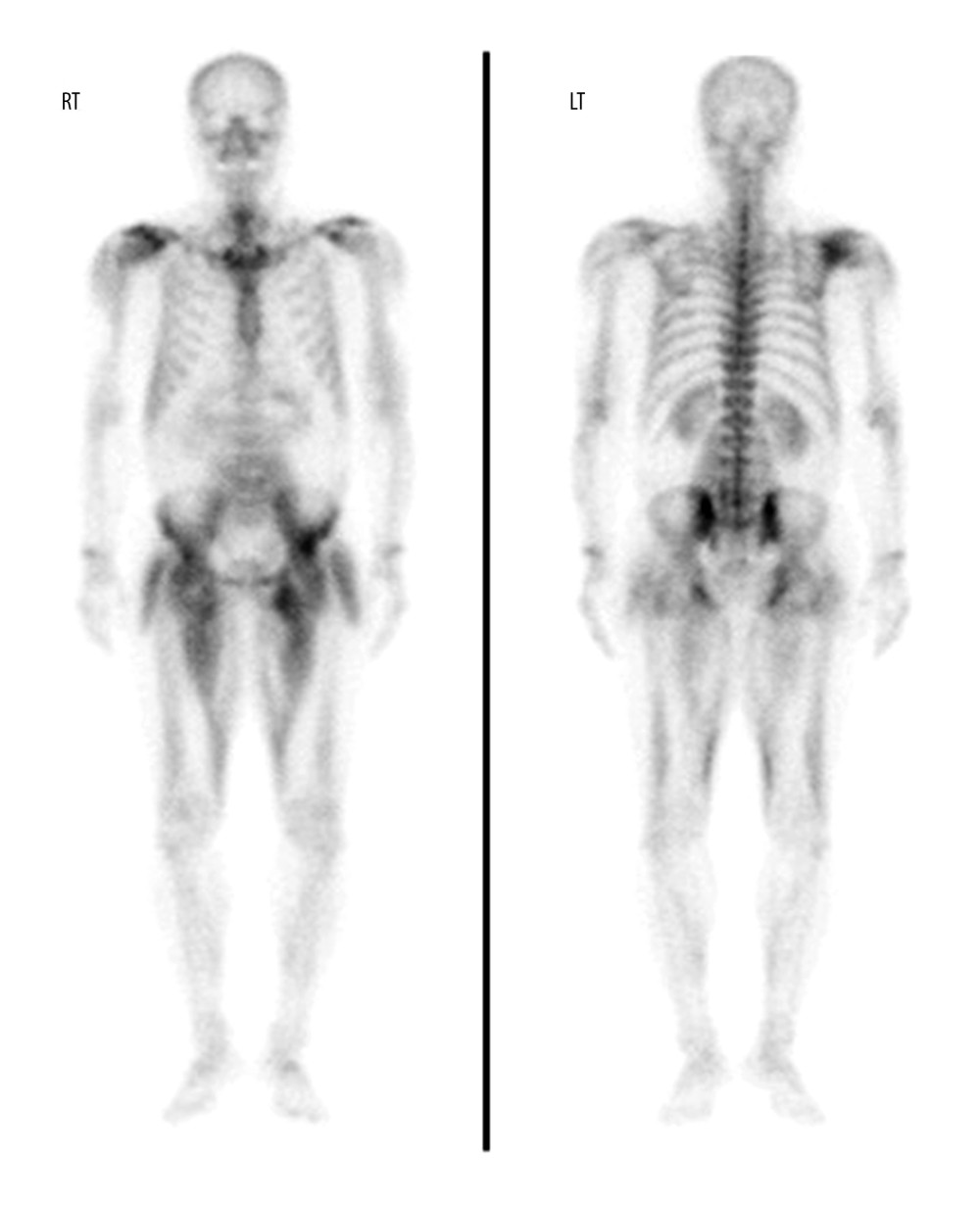 Bone scintigraphy with 99mTc-HDP on hospitalization day 7 showed increased isotope uptake in the both arms and legs. RT – right; LT – left.
