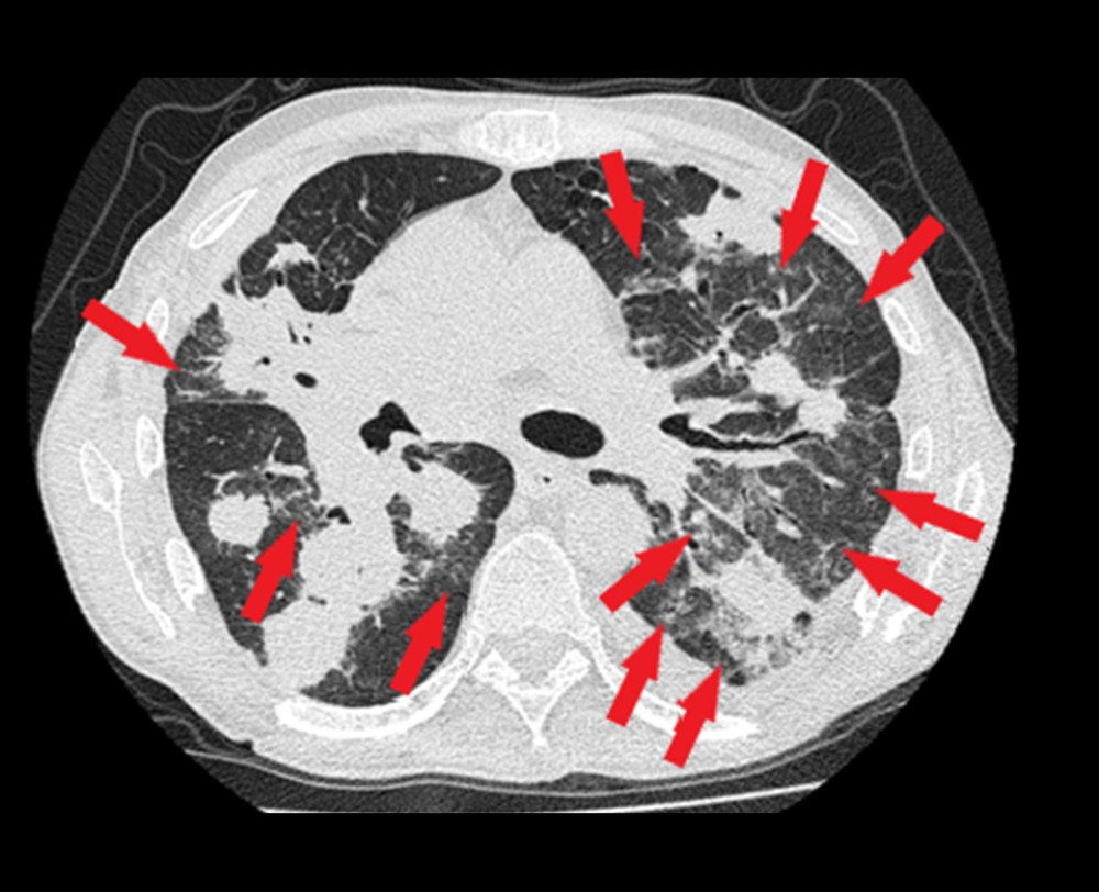 Chest high-resolution computed tomography: tumor in the hilum of the right lung, nodules in both lungs (metastases). Numerous macular, confluent parenchymal, and reticular opacities in the left lung, a smaller areas of similar opacities in the superior segment of lower lobe of the right lung (red arrows). Fluid in the left pleural cavity.