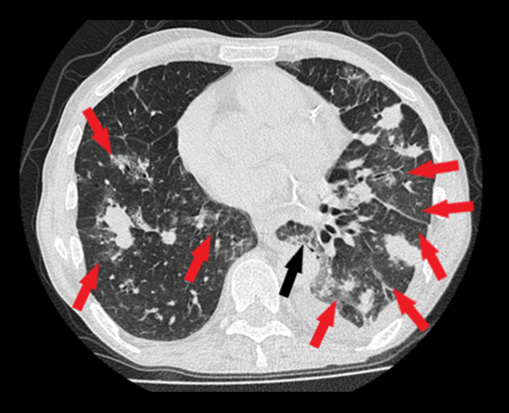Chest high-resolution computed tomography: nodules in both lungs (metastases); in the lower lobes of both lungs, numerous patchy, confluent parenchymal opacities with areas of ground-glass opacities (red arrows). Small area crazy-paving pattern in the left lung (black arrow). Fluid in the left pleural cavity.