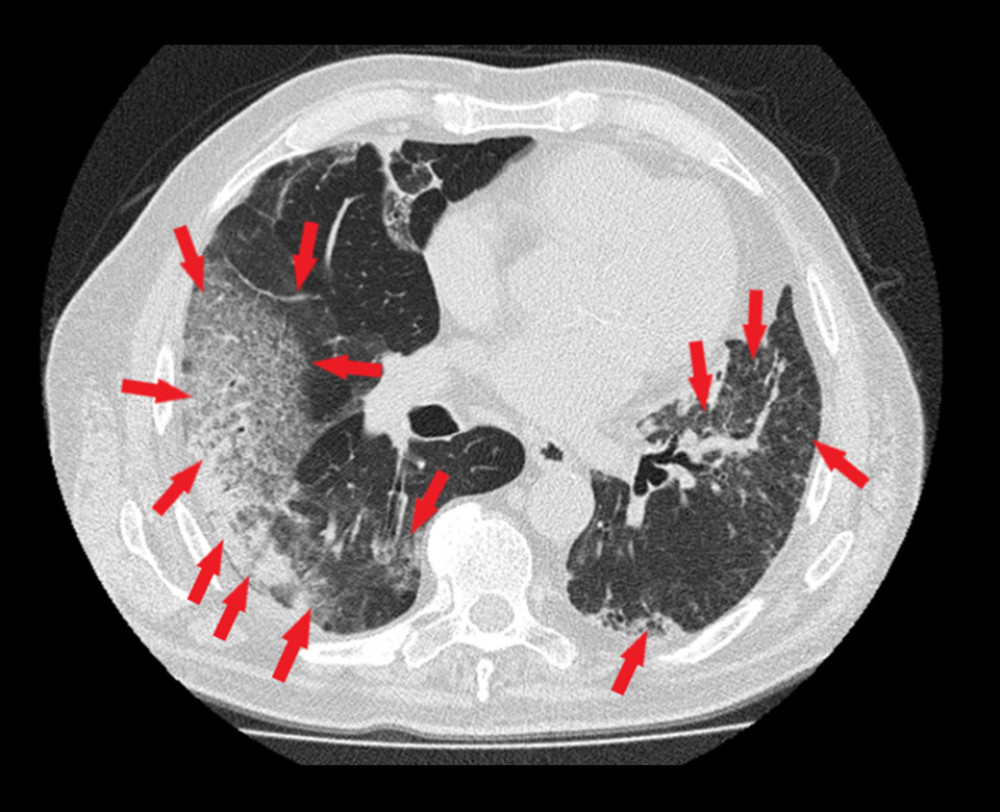 Chest high-resolution computed tomography: subpleural confluent areas of crazy-paving and consolidations, mainly on the right side (red arrows).