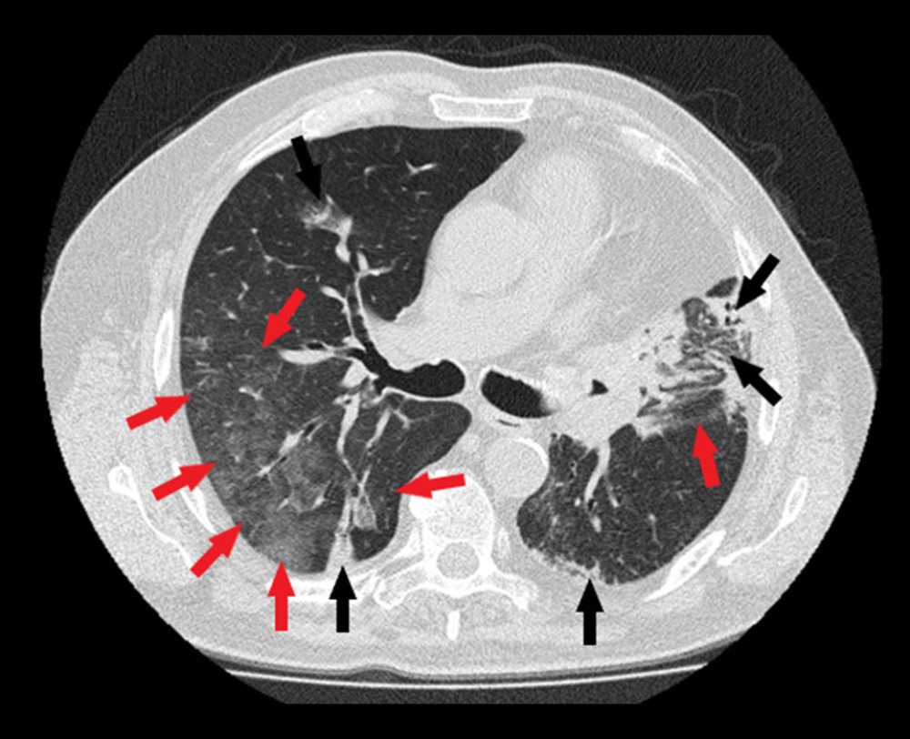Chest high-resolution computed tomography: areas of increased attenuation with ground-glass opacities (red arrows), scattered linear opacities, and consolidations (black arrows), mainly on left upper lobe.