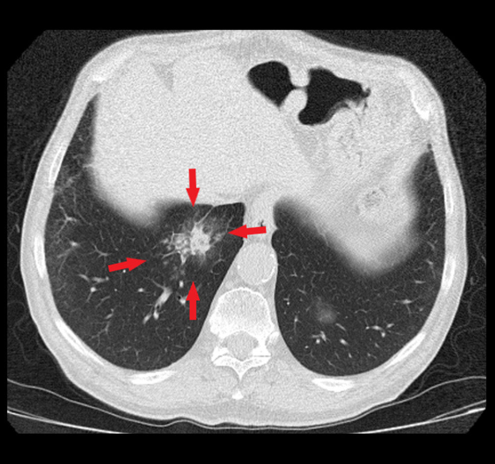 Chest high-resolution computed tomography: consolidation with halo sign and ground-glass opacities around in the posterior segment of right lower lobe (red arrows).