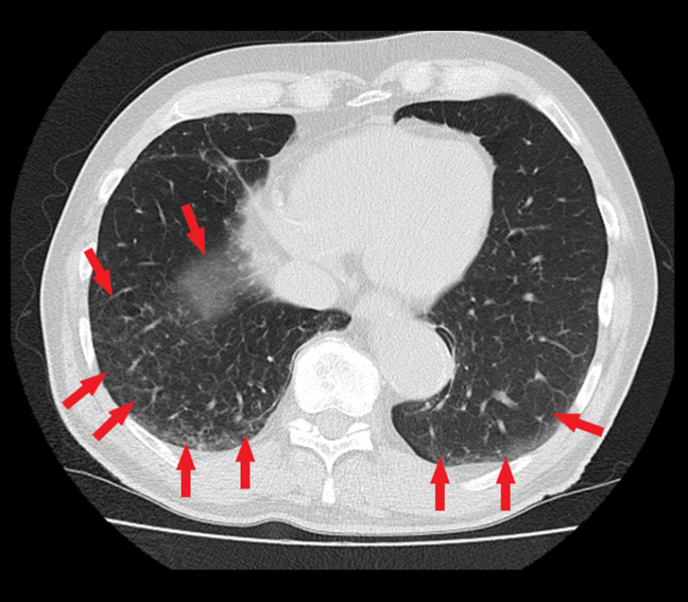Chest high-resolution computed tomography: reticular, subpleural, confluent opacities at the background of ground glass areas, mainly in the dorsal fields of lower lobes in both lungs (red arrows).
