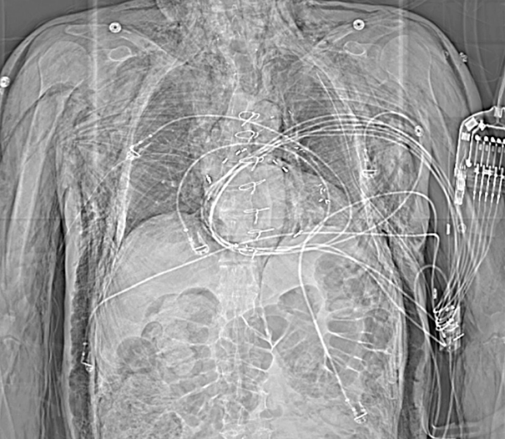 Scout film on presentation to the emergency department, with significant subcutaneous emphysema.