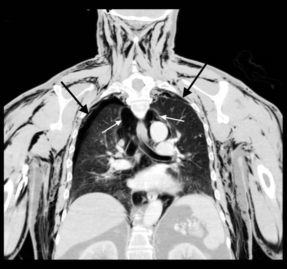 CT chest with bilateral pneumothoraces (black arrows), pneumomediastinum (white arrows), and extensive subcutaneous air throughout the neck, shoulder, and arm musculature.