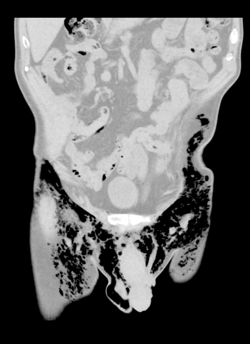 CT abdomen pelvis with diffuse subcutaneous emphysema of abdomen and scrotum.