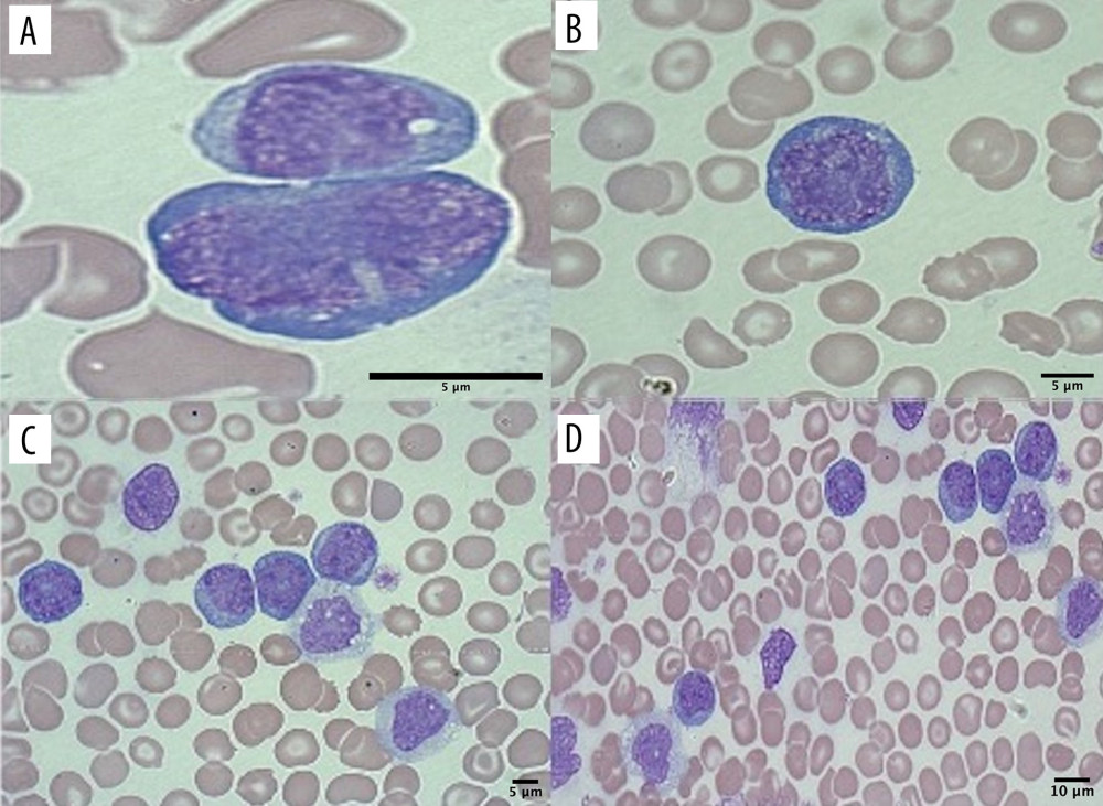 Peripheral smear showing high (A, B) and low power images (C, D) of the lymphoma cells that are medium in size with high nuclear/cytoplasmic ratio, partially dispersed chromatin with inconspicuous nucleoli and some nuclear convolutions. The cytoplasm is moderately basophilic with some vacuoles.
