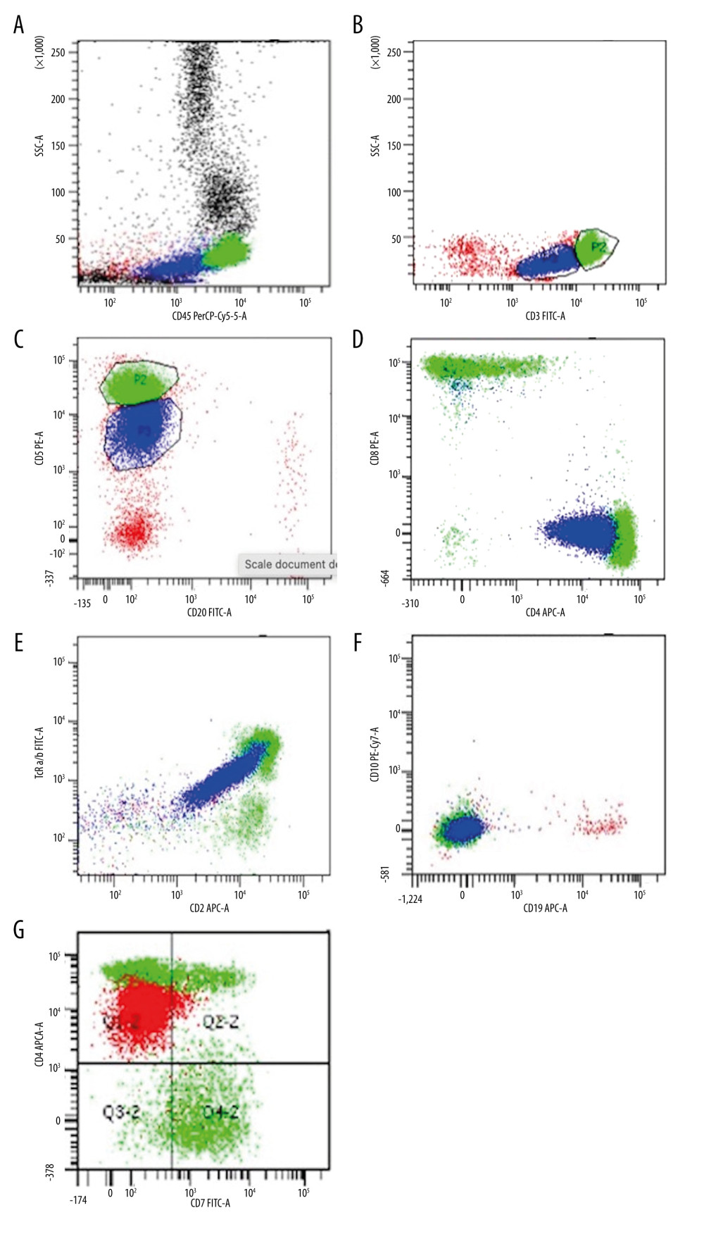 (A–G) Multiparameter flow cytometry (MFC) scattergram of the peripheral blood showing the immunophenotype of the lymphoma cells (the population seen in royal blue in all plots and in red in the last plot) which are positive for CD45, CD3, CD5, CD4, and CD2 but in a dimmer expression than the normal T lymphocytes (bright green population). In addition, they are positive for TCR a/b and show aberrant loss of CD7 (last plot). CD10, CD19, and CD20 are negative. SS – side scatter; APC – allophycocyanin; FITC – fluorescein isothiocyanate; PE – phycoerythrin; PE-Cy7 – phycoerythrin-cyanin5; PerCP-Cy5 – peridinin chlorophyll protein complex-cyanine 5.
