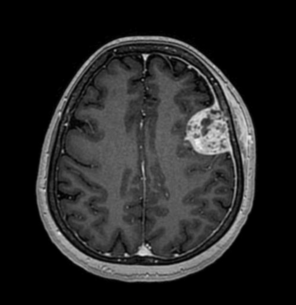 MRI brain prior to resection of the transcranial mass showing heterogeneous pattern of enhancement of the intracranial mass.