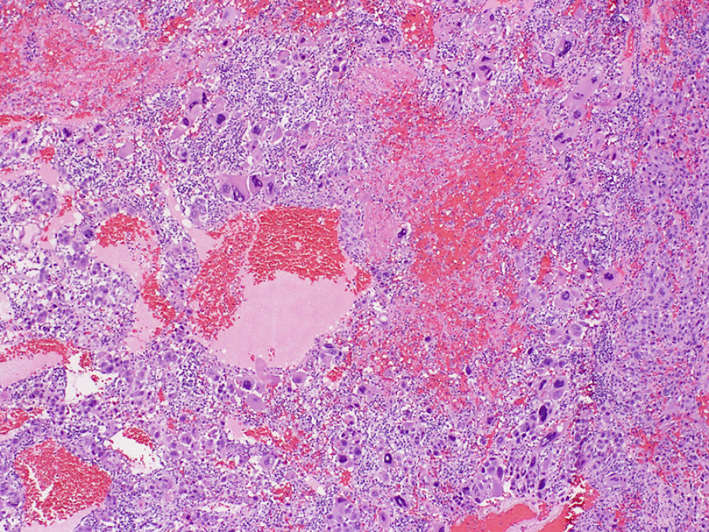 Hematoxylin and eosin stain: highly cellular and anaplastic neoplasm with extensive hemorrhage.