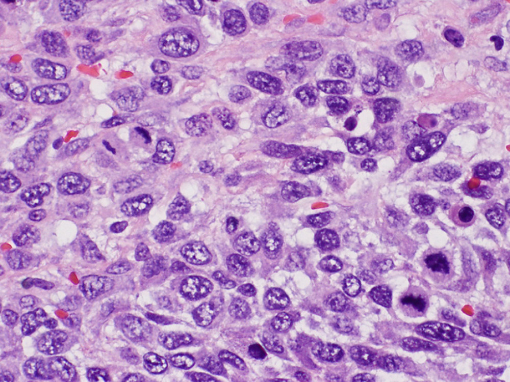 Hematoxylin and eosin stain (400×). Cytotrophoblasts are mononucleated polygonal cells with clear cytoplasm and large vesicular nucleoli. Syncytiotrophoblasts are large multinucleated cells with eosinophilic cytoplasm and hyperchromatic nuclei.