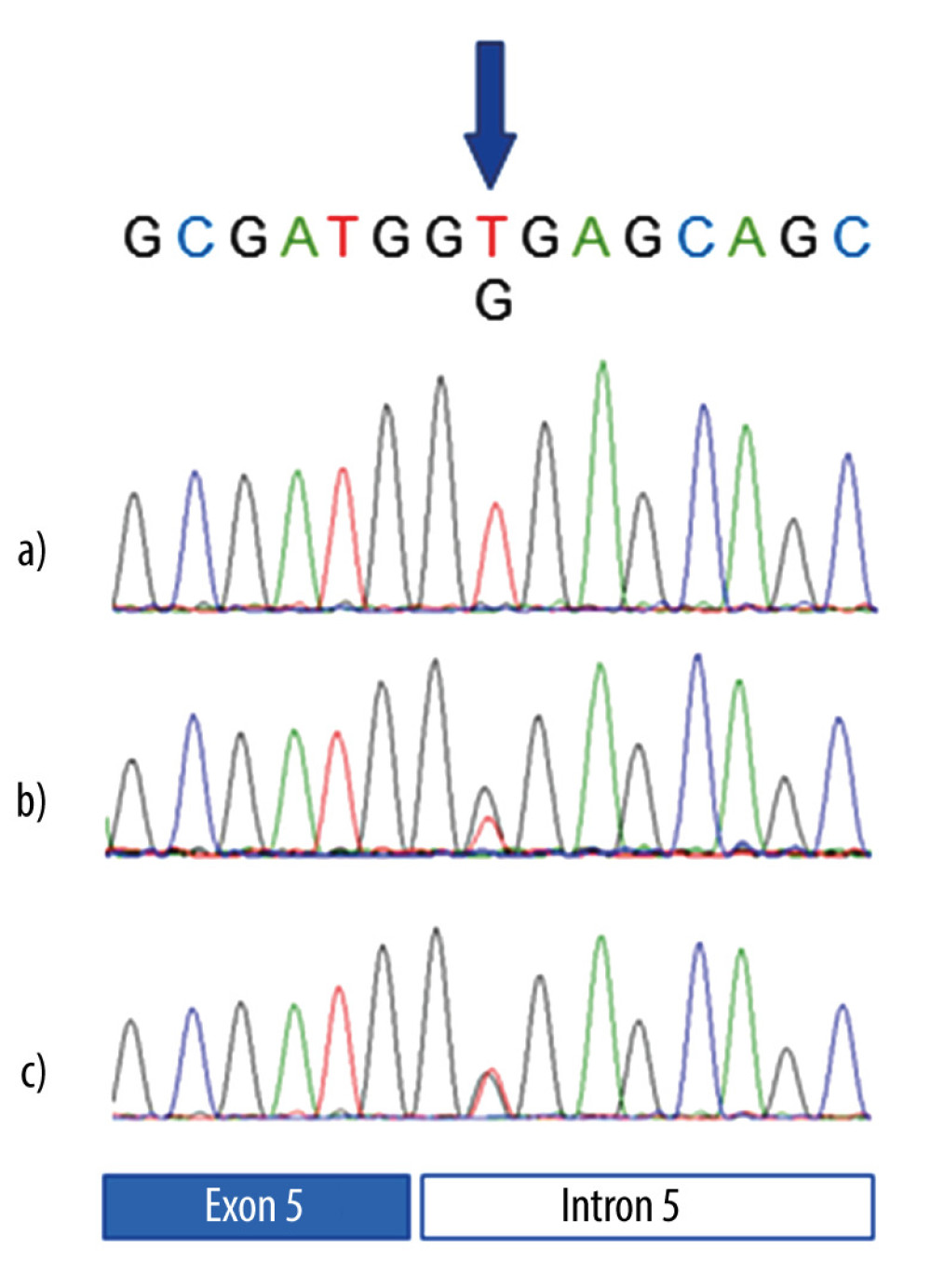 Sequencing analysis of the TP53 gene in the patient. a), b), and c) represent fingernails, blood, and buccal swab, respectively. The pathogenic variant was detected in the blood and the buccal swab, but not in the fingernail.