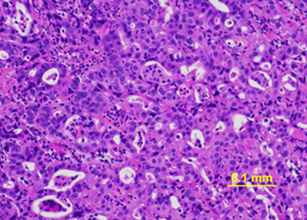 Hematoxylin and eosin-stained gastric cancer biopsy sample. The estimated proportions of tumor cells, inflammatory infiltrates, and normal cells are 30–40%, 50%, and 10%, respectively.