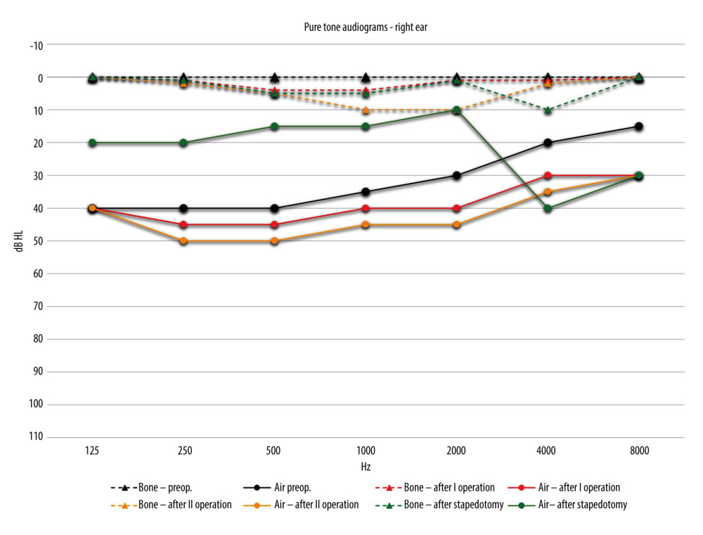 Congenital stapes suprastructure fixation presenting with