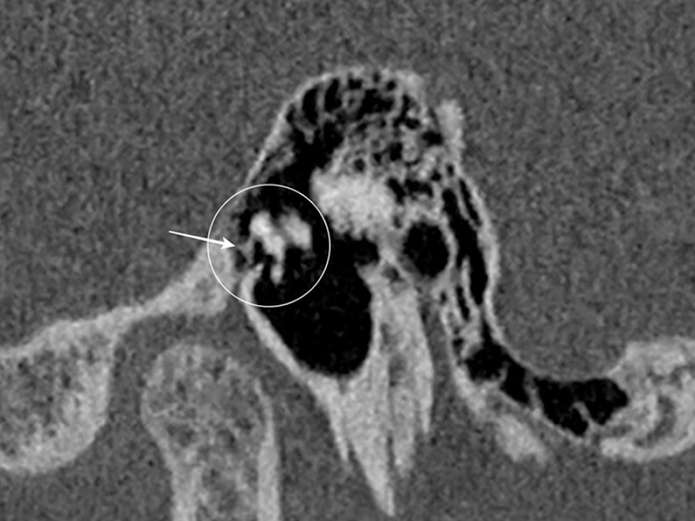 Right ear HRCT, sagittal view. A linear structure present between the malleus and the anterior wall of the epitympanum (white arrow). It was the cause of the malleus head immobilization in the attic.