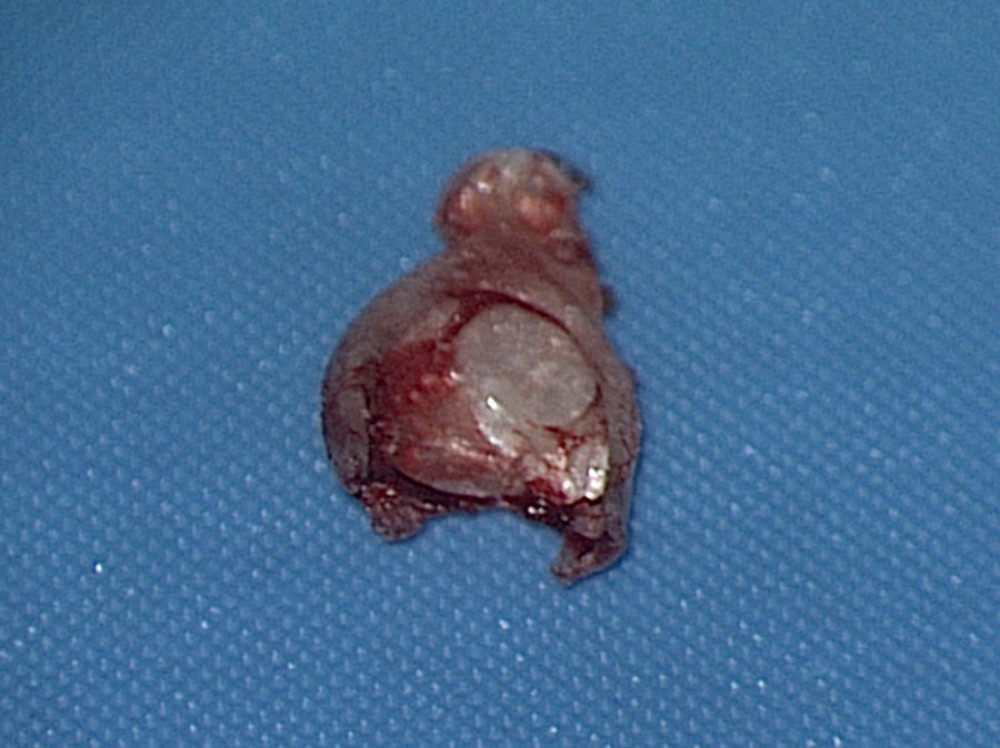 Abnormal structure of the stapes. Atypical crura, thickened and fused into a single arch. View from the promontory side.