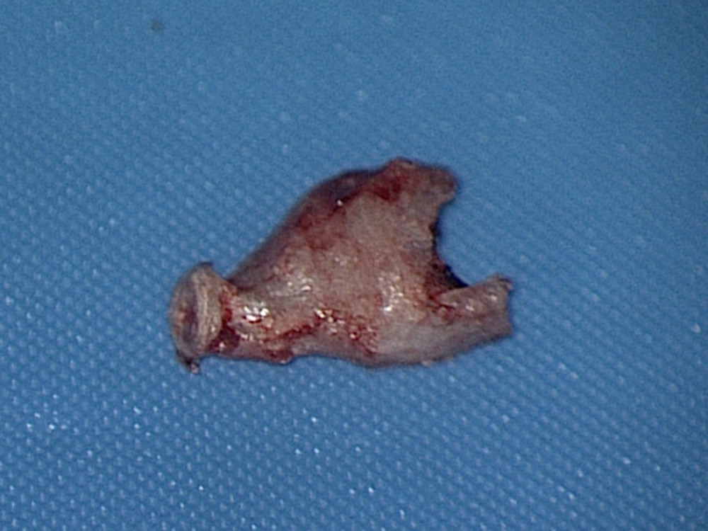 Abnormal structure of the stapes. Atypical crura, thickened and fused into a single arch. Seen from the side of the facial nerve.