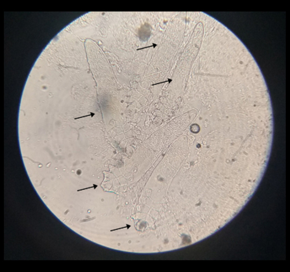 Five adult organisms of Demodex mites (arrows) under microscope in evaluation of scrapings of the face.