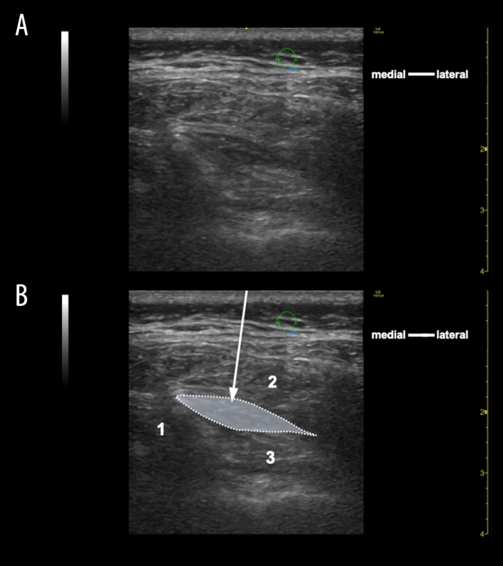 Ultrasonographic images showing the position and hydrodissection process between the right semispinalis capitis and obliquus capitis inferior muscles. (A, B) During hydrodissection (out-of-plane technique). Arrow shows the location of the needle. The dotted line indicates the range of solutions injected. (1) C2 spinous process; (2) semispinalis capitis muscle; and (3) obliquus capitis inferior muscle.