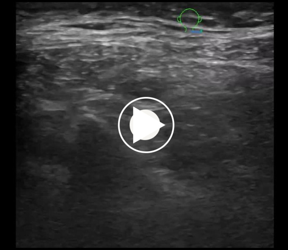 Ultrasonographic movie showing hydrodissection process between the right semispinalis capitis and obliquus capitis inferior muscles.