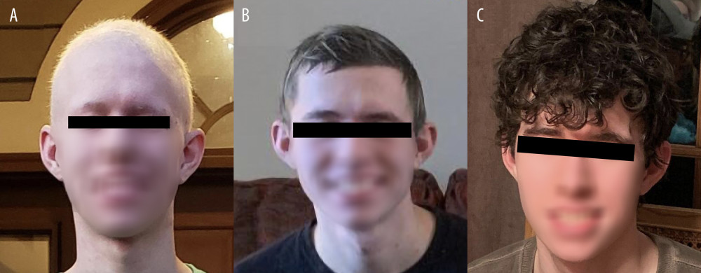 Clinical response to dupilumab at (A) 4 months, (B) 8 months with almost complete hair growth, and (C) at 3 years on dupilumab therapy with no evidence of recurrence at 3 years.
