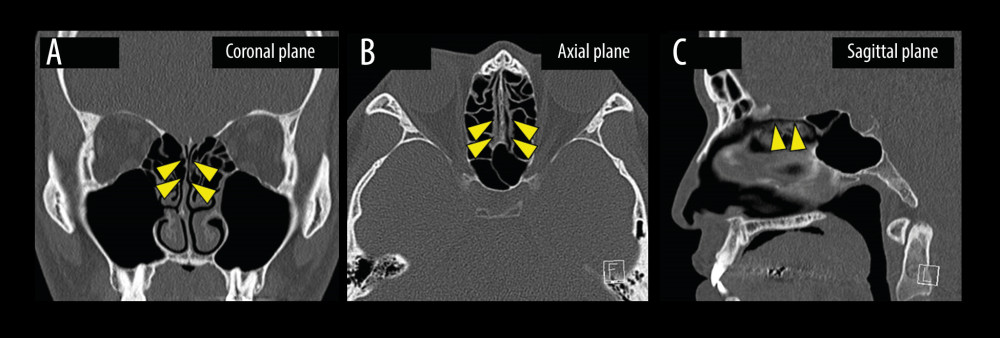 CT image shows no sinusitis or inflammation in the olfactory cleft. (A, B) There is no inflammatory obstruction in the bilateral olfactory clefts (arrowheads). (C) There is no inflammatory obstruction in the right olfactory clefts (arrowheads). CT – computed tomography.