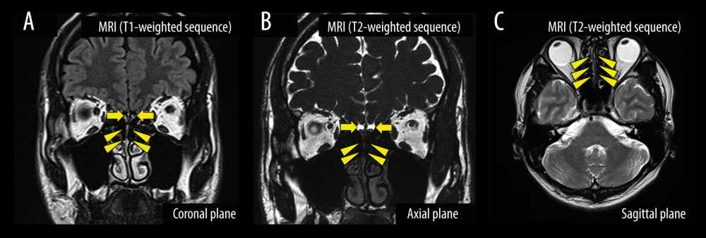MRI image. (A–C) MRI; the olfactory bulbs (arrow) appear normal, and there is no inflammatory obstruction in the bilateral olfactory clefts (arrowheads). MRI – magnetic resonance imaging.
