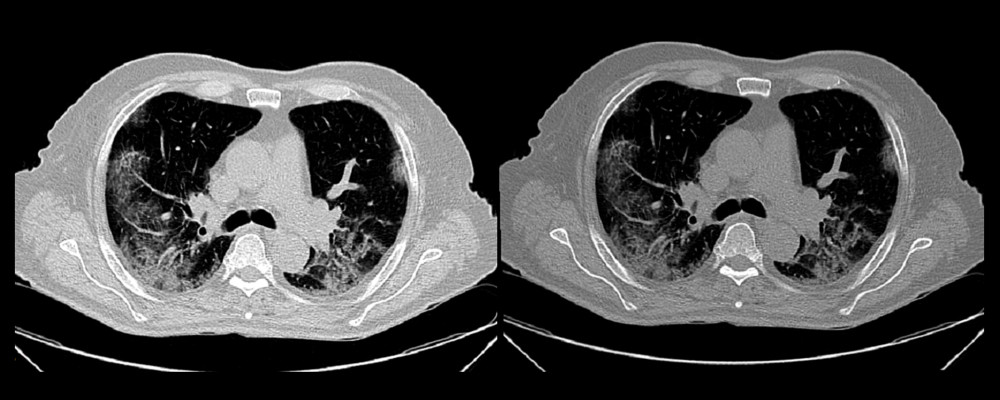 Chest computed tomography scan showing bilateral ground-glass pulmonary infiltrates.