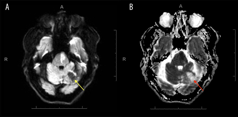Magnetic resonance imaging of the paramedian pontine infarction. Magnetic resonance imaging with diffusion-weighted imaging displays hyperintensity in the left paramedian pontine (A) indicated by a yellow arrow, with apparent diffusion coefficient correlate (B) indicated by a red arrow.