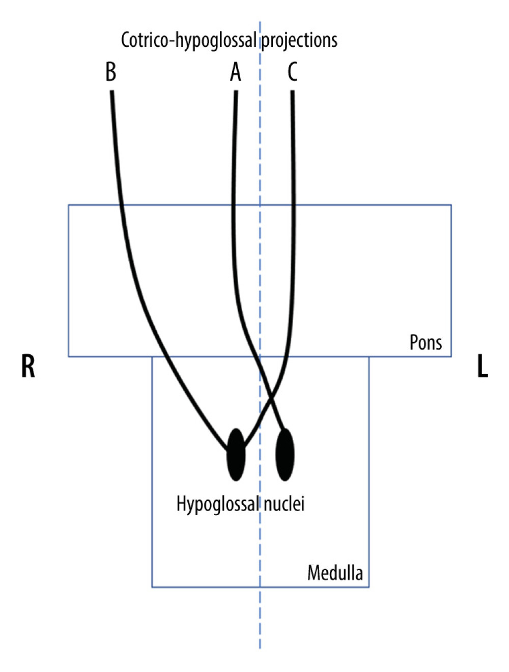 Diagrammatical representation of different patterns of the cortico-hypoglossal fibers. Diagrammatically, Line A represents contralateral cortico-hypoglossal fibers that decussate at the pontomedullary junction; Line B represents ipsilateral cortico-hypoglossal fibers; Line C represents the contralateral cortico-hypoglossal fibers with decussation different from the pontomedullary junction (more caudal in this case).