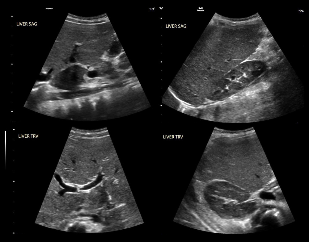 Preoperative liver ultrasound showing hepatomegaly with diffuse increased parenchymal echogenicity.