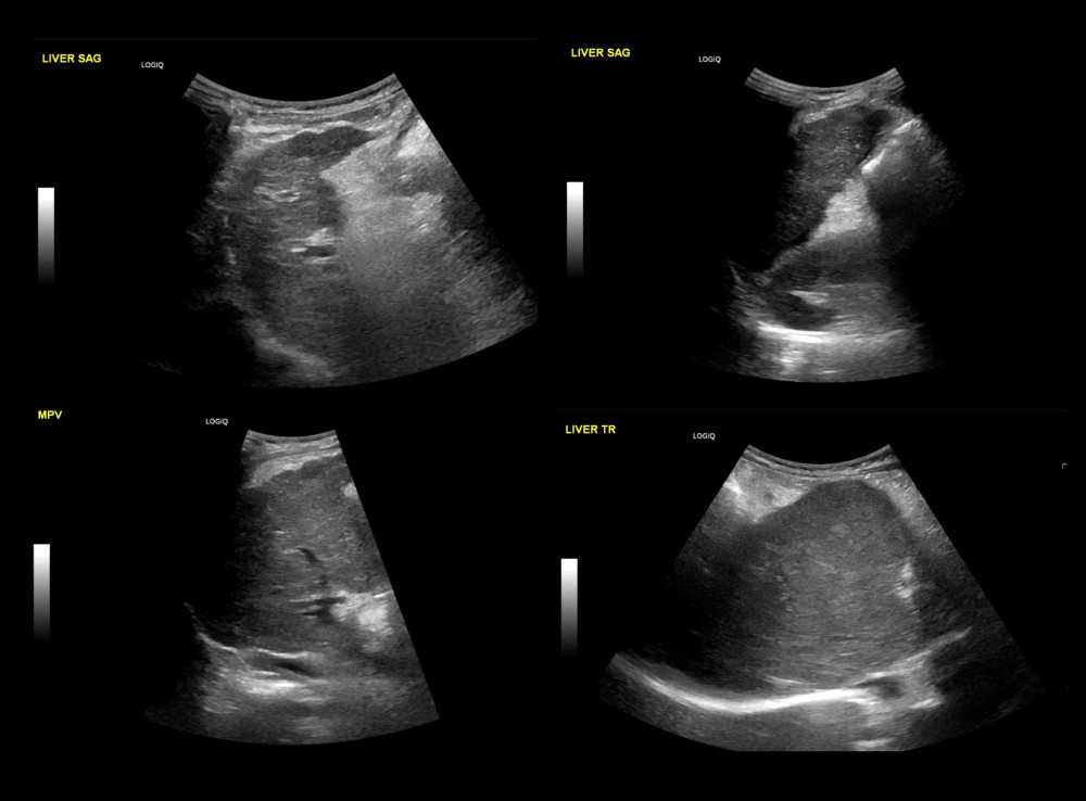 Preoperative liver ultrasound showing cirrhotic liver.