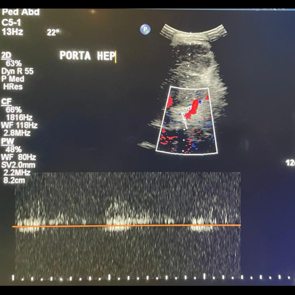 Preoperative liver Doppler ultrasound showing no portal color flow or Doppler wave form indicating portal vein thrombosis.