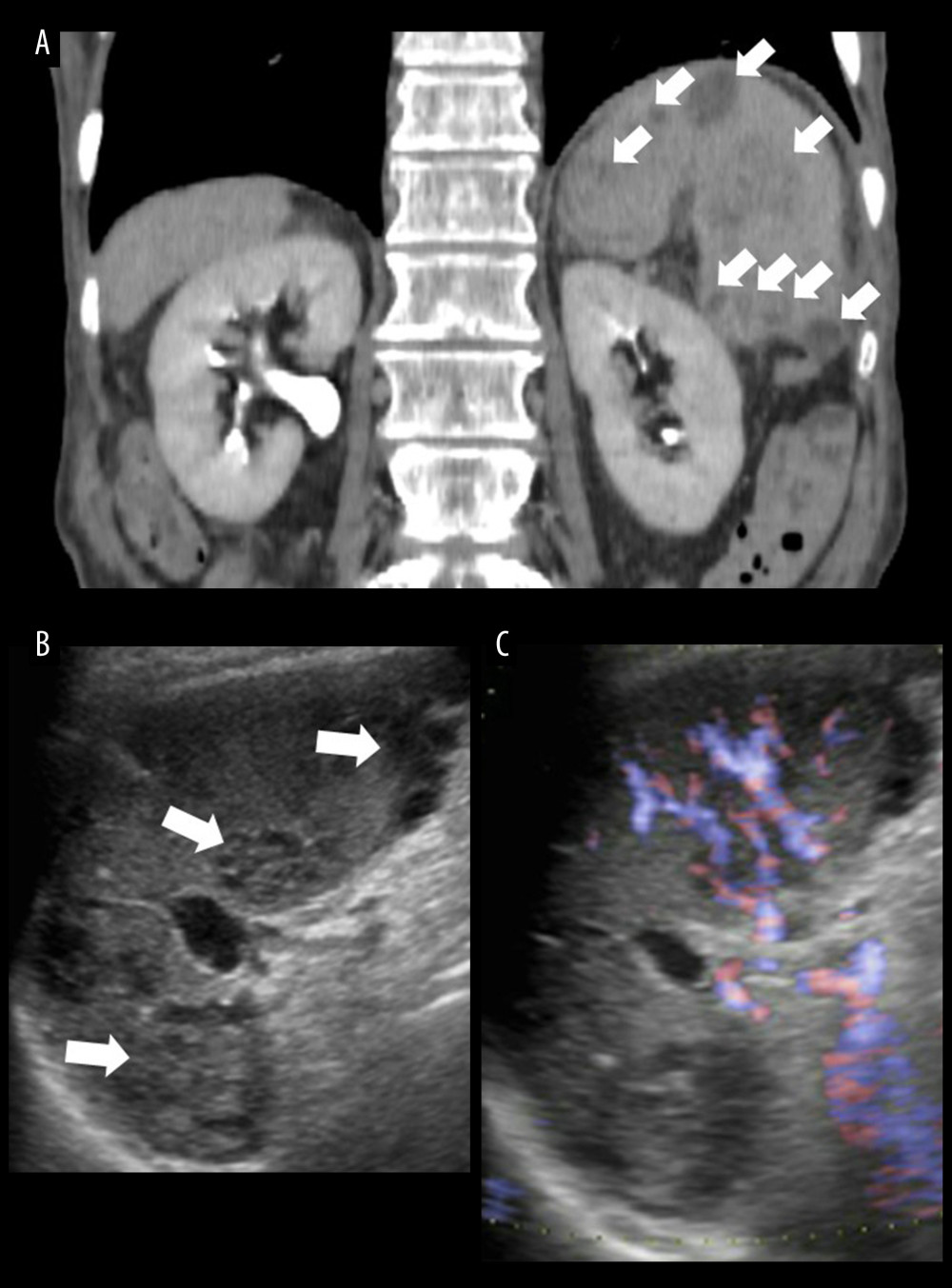 Images of the splenic abscesses. (A) Coronal section of contrast-enhanced computed tomography. The spleen was enlarged. Splenic abscesses appeared as multiple lesions with irregular margins and low resorption (arrows). Trace fluid accumulation was present (not shown). (B) Ultrasonography. The splenic abscesses showed irregular margins and mixed echogenicity inside (arrows). (C) Doppler ultrasound. The splenic abscesses were avascular.