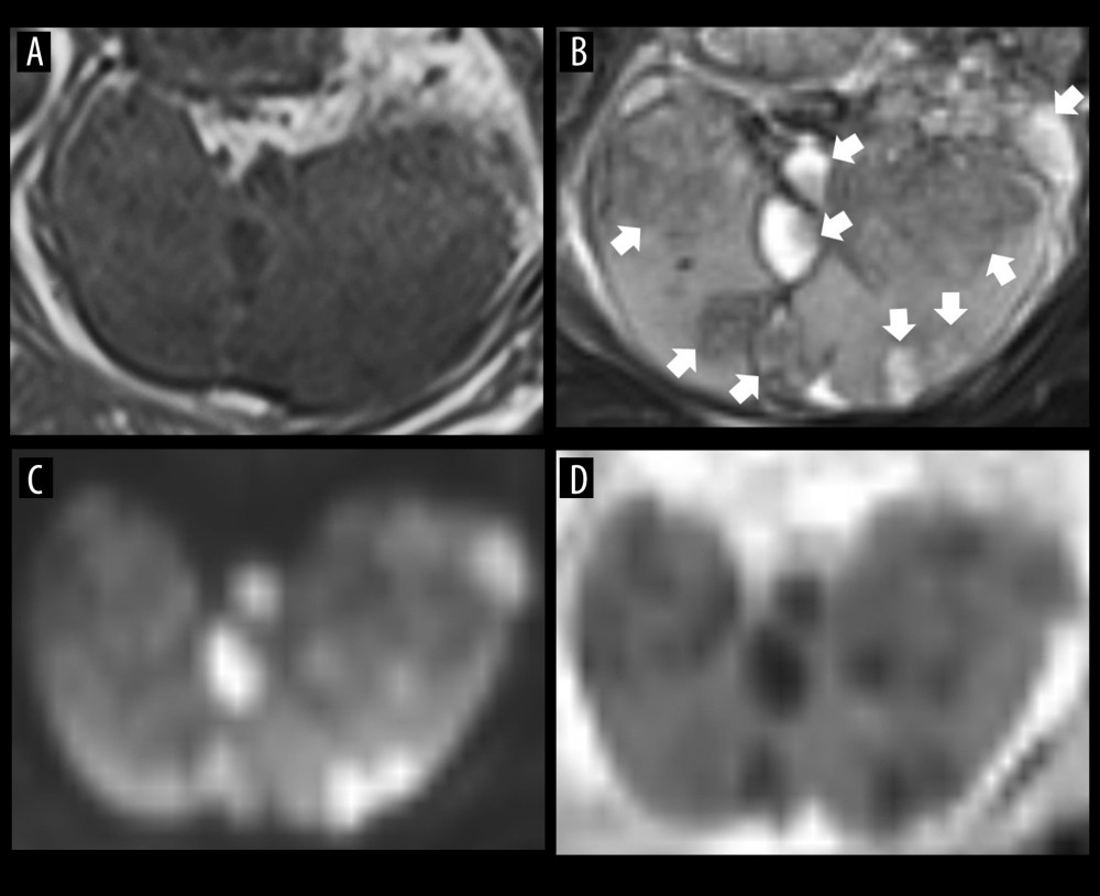 Magnetic resonance imaging. (A) T1-weighted image. (B) T2-weighted image. (C) Diffusion-weighted image. (D) Apparent diffusion coefficient image. Splenic nodules (arrows) had mixed high and low signals on both T1- and T2-weighted images. Nodules that showed high signal on T2-weighted images had high signal on diffusion-weighted images and low signal on ADC images, suggesting inflammation or malignancy.