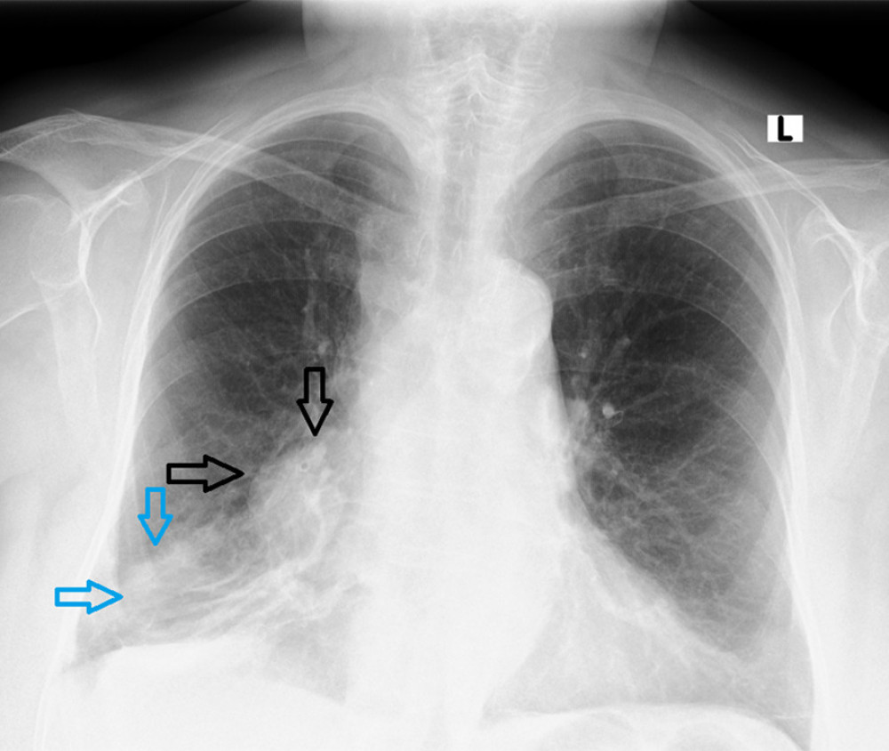 Chest X-ray (posteroanterior) showing widening of the shadow of the right hilum (black arrows) with areas of interstitial densities in the middle lobe (blue arrows). The picture corresponds to the tumor. There are atherosclerotic lesions of the aortic arch.