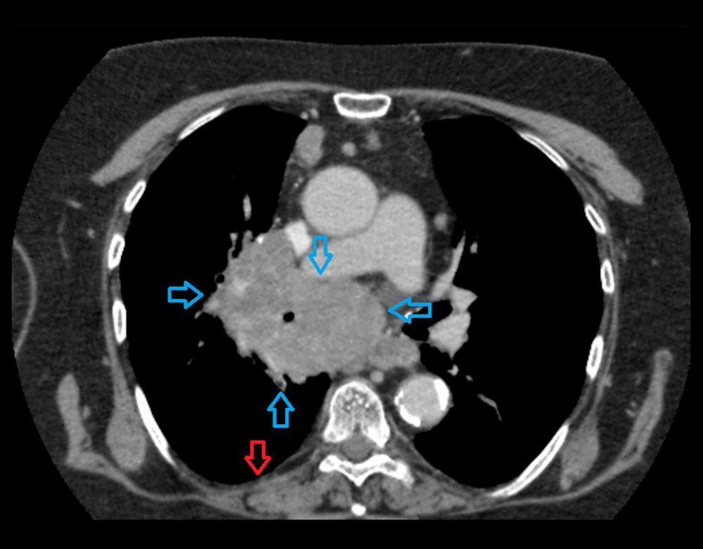Computed tomography scan of the chest and abdominal cavity with contrast agent (08.2021) showing, in the right hilum, extensive tumor infiltrating mediastinum, merging with pathological nodal masses, dimensions: 79×77×137 mm (blue arrows) and a small amount of fluid in the right pleural cavity in a layer of about 10 mm (red arrows).