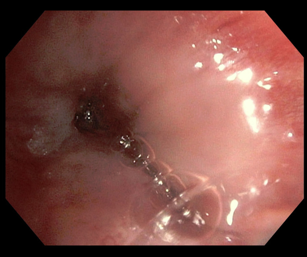 Broncho-fiberscope showing narrowed intermediate bronchus of the right lung, circularly infiltrated by neoplasm masses.